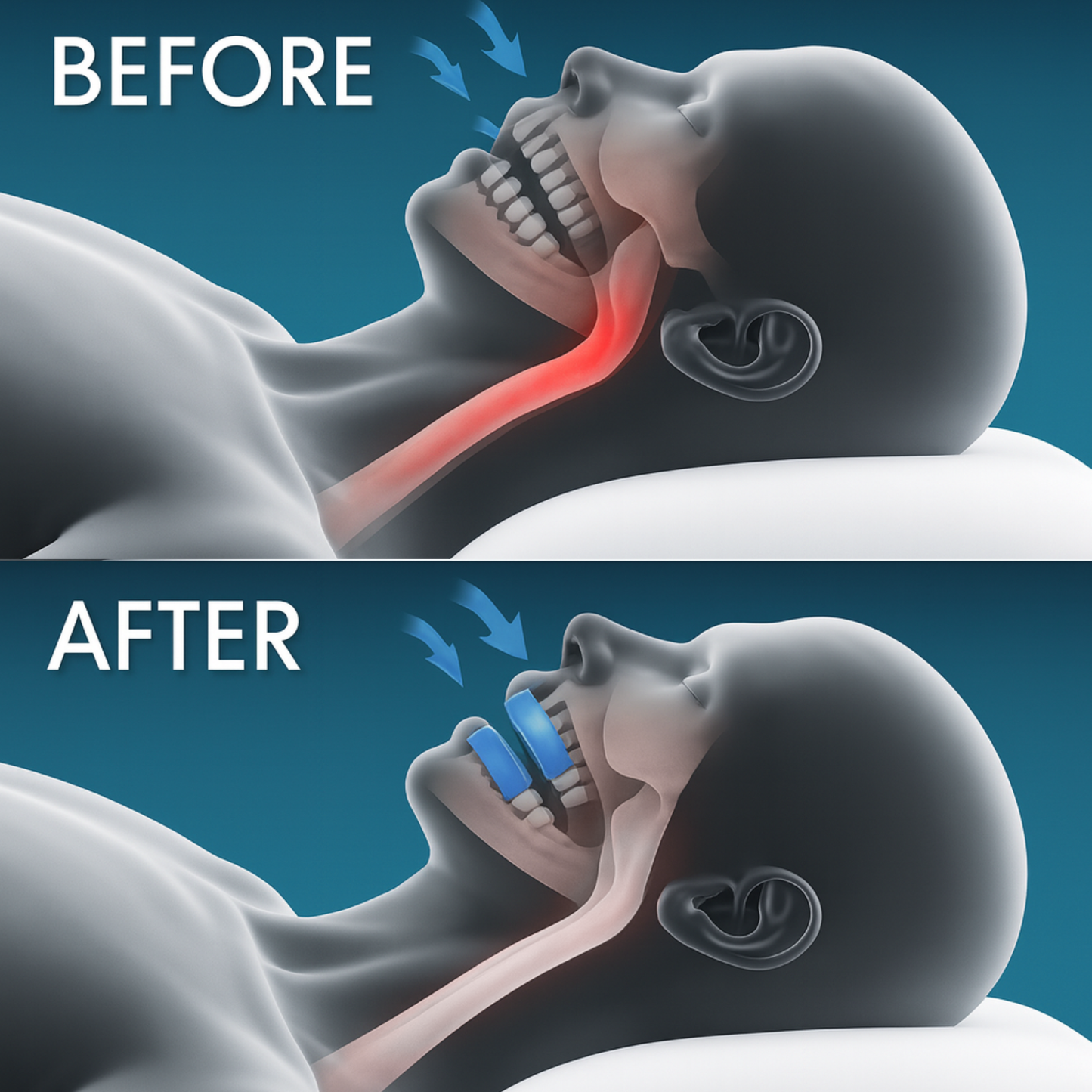 NEW 24Quiet® Anti Snoring Mouth Guard